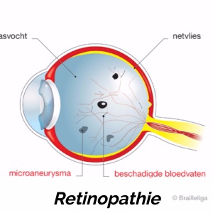 retinopathie