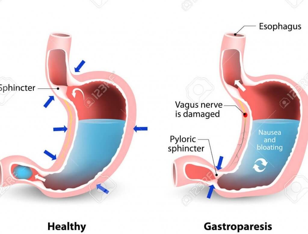 gastroparese is een vorm van neuropathie bij diabetes