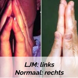 limited joint mobility (LJM)