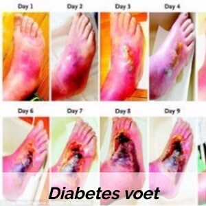 diabetische voet gevolgen van diabetes