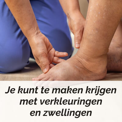 verkleuringen diabetische voet verkleuringen diabetische voet